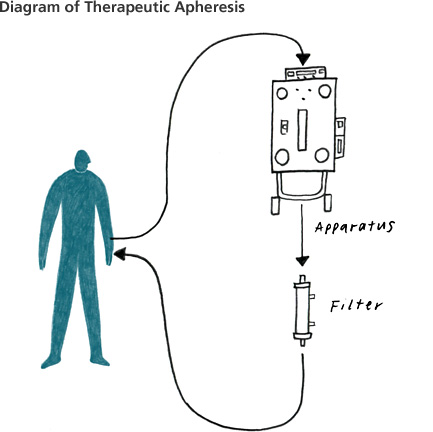 Diagram of therapeutic apheresis