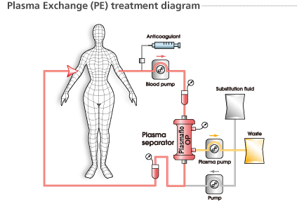 Plasma Exchange (PE) treatment diagram