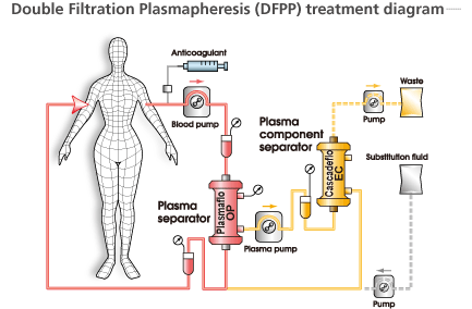 Double Filtration Plasmapheresis (DFPP) treatment diagram