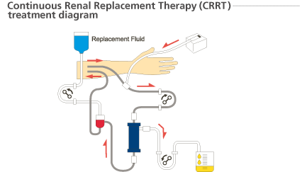 Continuous Renal Replacement Therapy (CRRT) treatment diagram