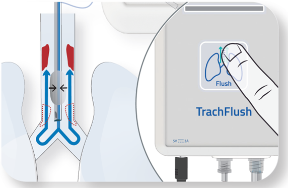 A unique cuff pressure control aligned with ventilator flow