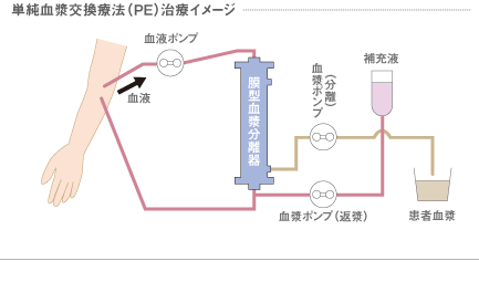 単純血漿交換療法イメージ