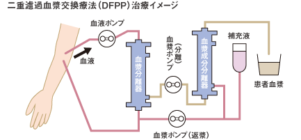 二重濾過血漿交換療法治療イメージ