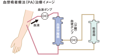 血漿吸着療法治療イメージ