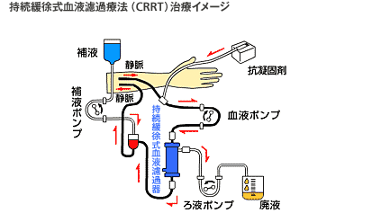 持続緩除式血液濾過療法（CRRT）治療イメージ