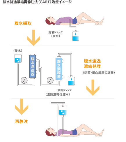 腹水濾過濃縮再静注法（CART）治療イメージ