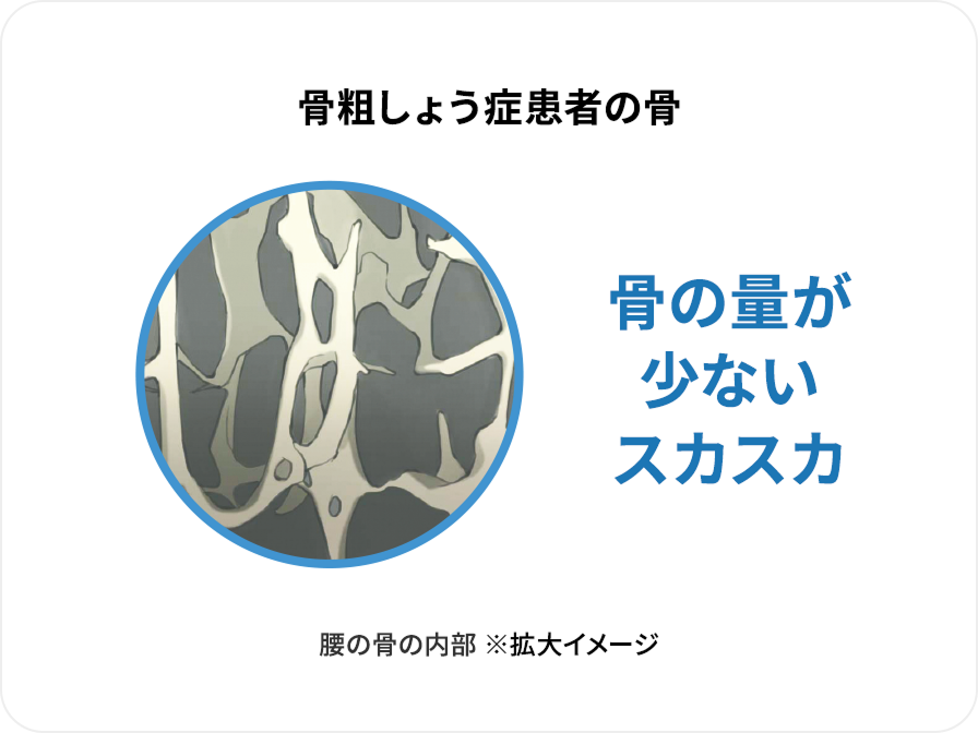 骨粗しょう症患者の骨