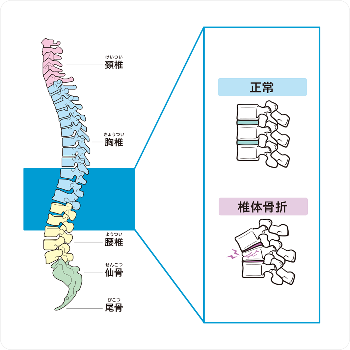 圧迫骨折