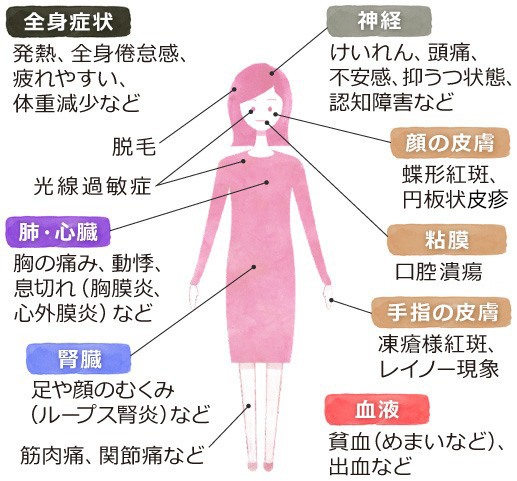 【SLEの主な症状】 