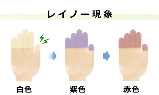 レイノー現象