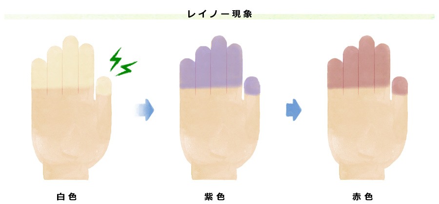 レイノー現象