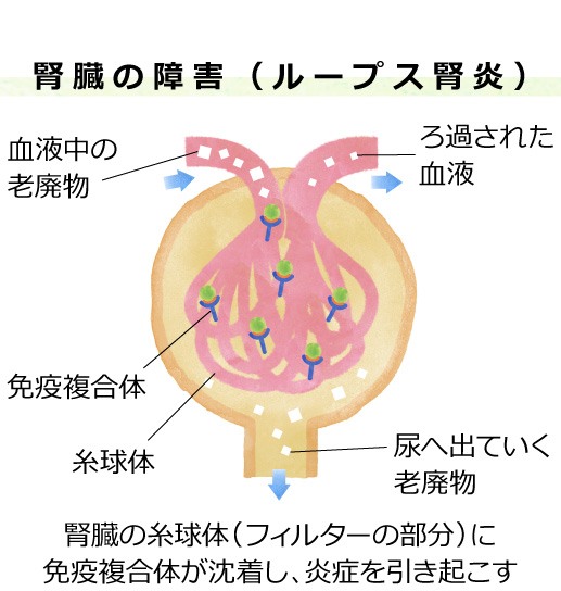 ループス腎炎