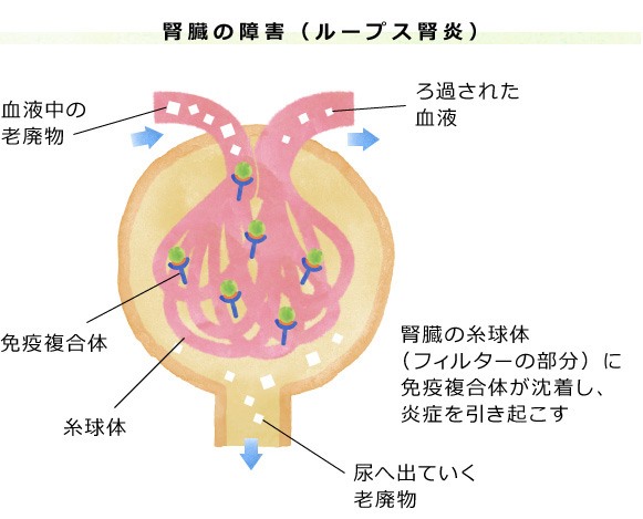 ループス腎炎